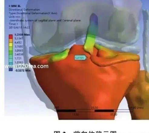 官方：高迪左膝内侧半月板后角撕裂，恢复时间为4周